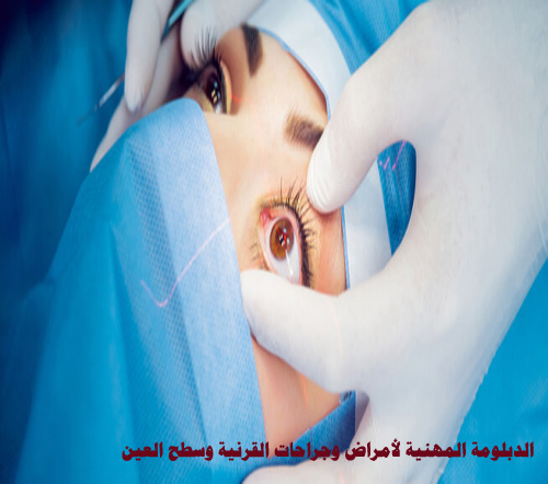 الدبلومة المهنية لأمراض وجراحات القرنية وسطح العين