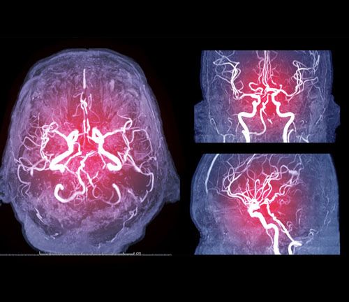 وحدة الجلطة الدماغية والأشعة العصبية التداخلية